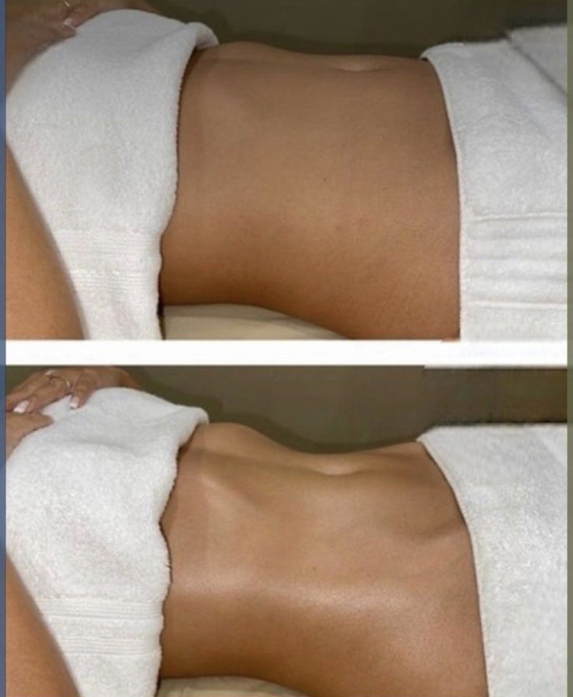 Aplicación de carboxiterapia en rostro
