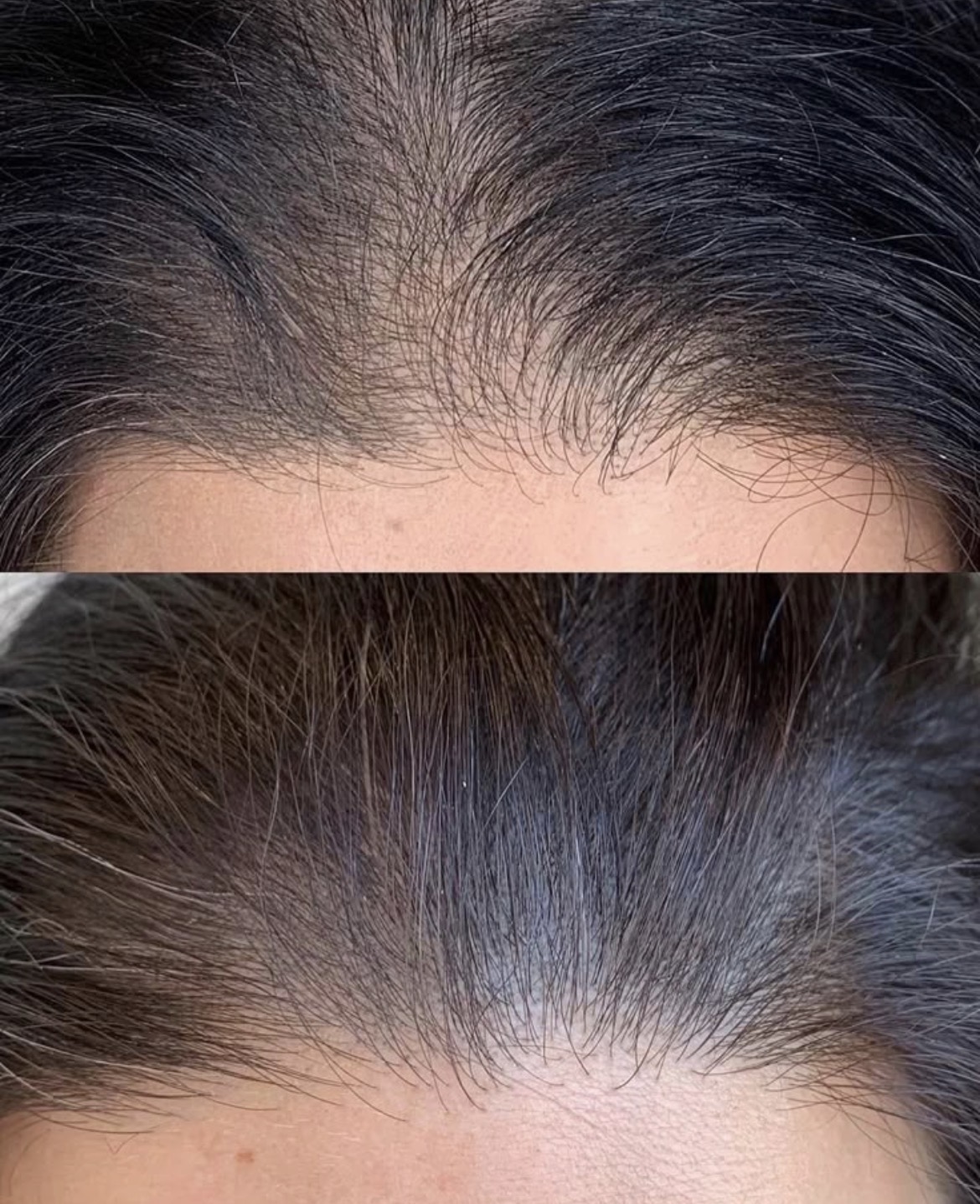 Comparación antes y después de tratamiento capilar en la línea frontal