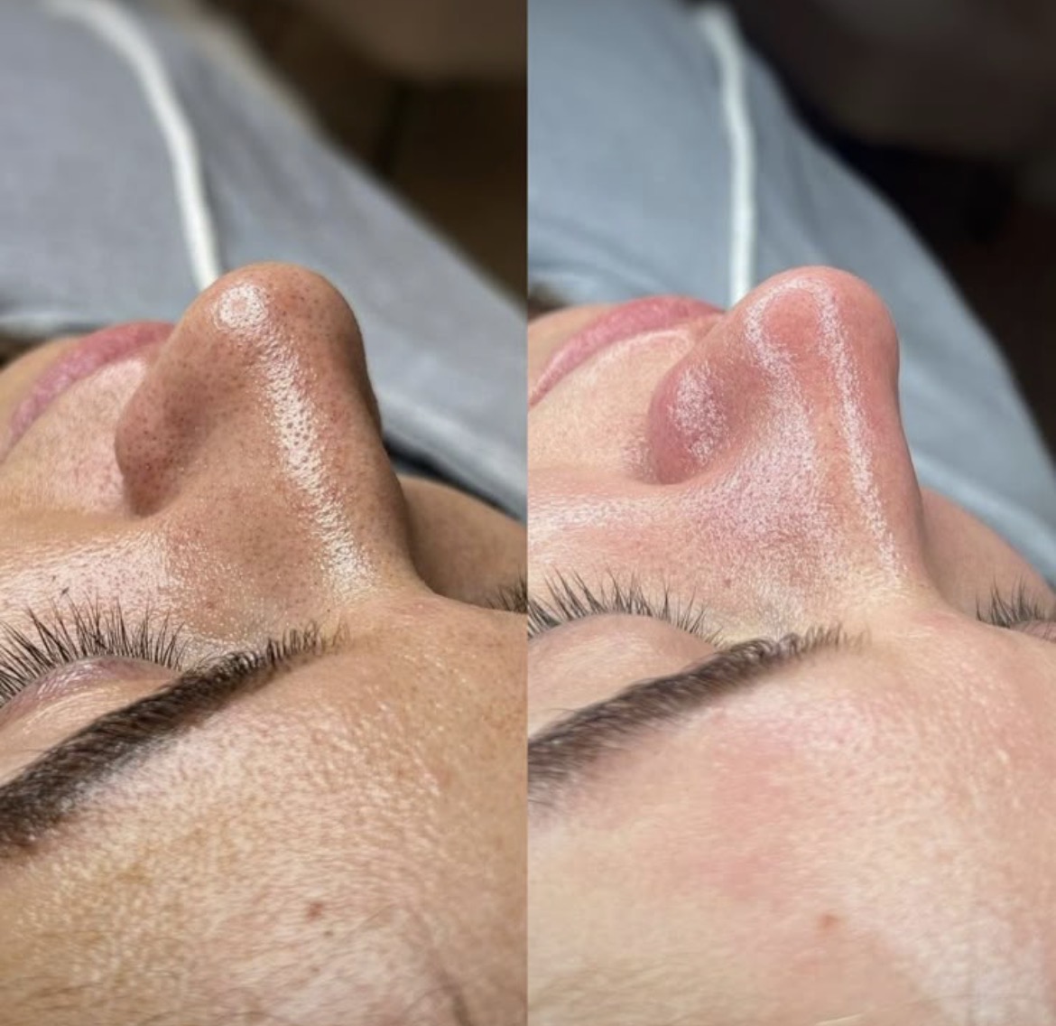 Antes y después de limpieza facial profunda en nariz
