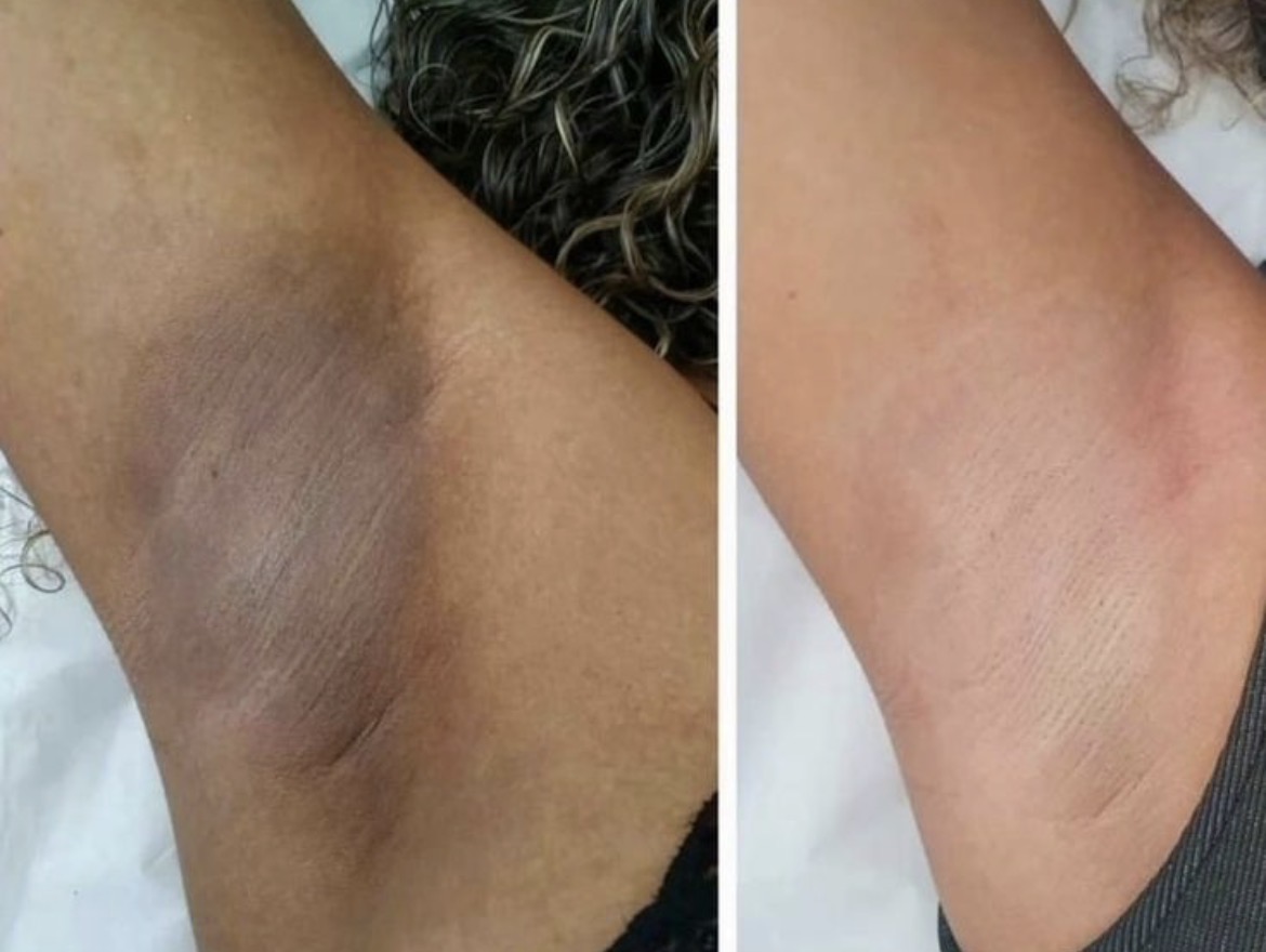 Comparación antes y después de tratamiento despigmentante en axila